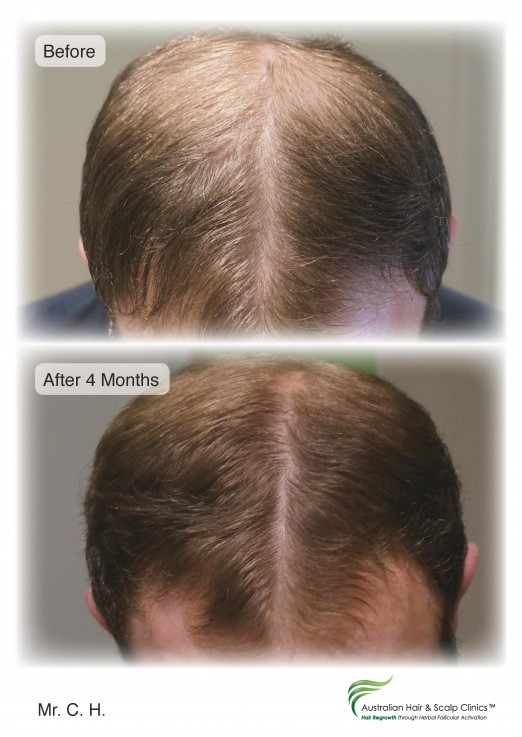 Are You Facing Hair Loss in Gold Coast?