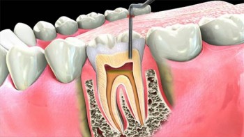 Best root canal treatment in Burnside - Parkwood Green Dental