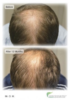 Searching for a Natural Hair Regrowth Treatment in Brisbane?