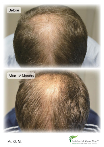 Searching for a Natural Hair Regrowth Treatment in Brisbane?