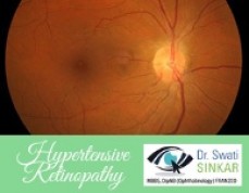 How Does Hypertensive Retinopathy Affect Your Vision | Dr. Swati Sinkar