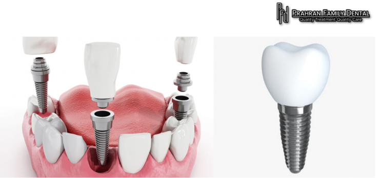  Best Teeth Implant dentistry treatment | Prahran Family Dental