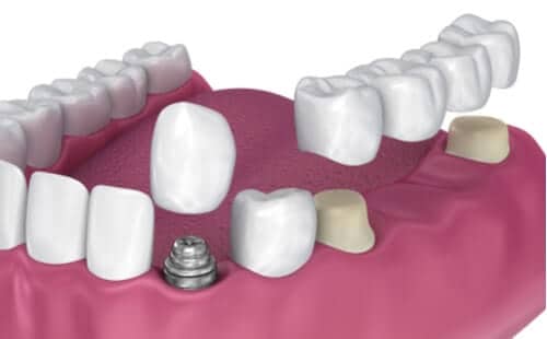 Two Emergency Dental Appointment Times During Opening Hours