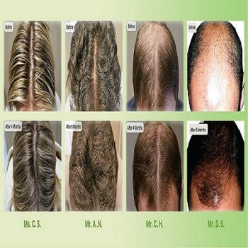 Do You Need Hair Loss Treatment in Canberra?