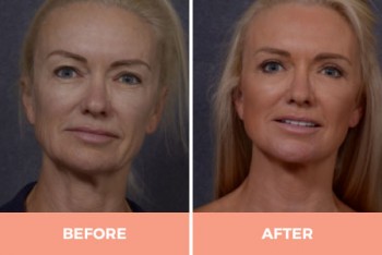 Effective Mid & Lower Facelift Surgery in Sydney By Dr. Hodgkinson - CALL US TODAY!