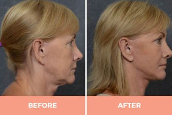 Effective Mid & Lower Facelift Surgery in Sydney By Dr. Hodgkinson - CALL US TODAY!