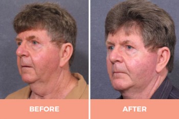 Effective Mid & Lower Facelift Surgery in Sydney By Dr. Hodgkinson - CALL US TODAY!