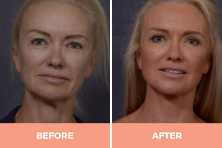 Effective Mid & Lower Facelift Surgery in Sydney By Dr. Hodgkinson - CALL US TODAY!