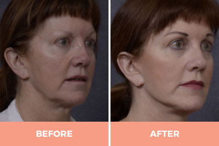 Effective Mid & Lower Facelift Surgery in Sydney By Dr. Hodgkinson - CALL US TODAY!