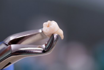 Need Tooth Extraction in Carrum Downs?