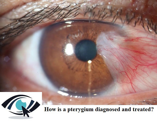 Eye Specialist Adelaide - How Does Pterygia Impact On Your Vision