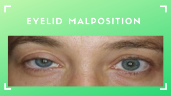 Eyelid Malposition & How to Treat It | Eye Specialist Adelaide