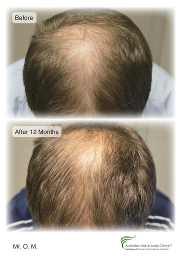 Nourish your hair with our hair loss treatment in Melbourne  