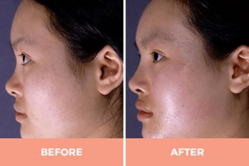 Expert Asian Rhinoplasty in Sydney Performed by Dr Hodgkinson!