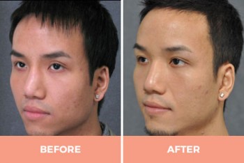 Expert Asian Rhinoplasty in Sydney Performed by Dr Hodgkinson!