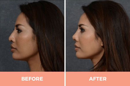 Expert Asian Rhinoplasty in Sydney Performed by Dr Hodgkinson!