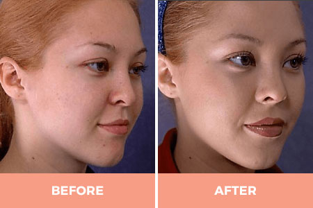 Expert Asian Rhinoplasty in Sydney Performed by Dr Hodgkinson!