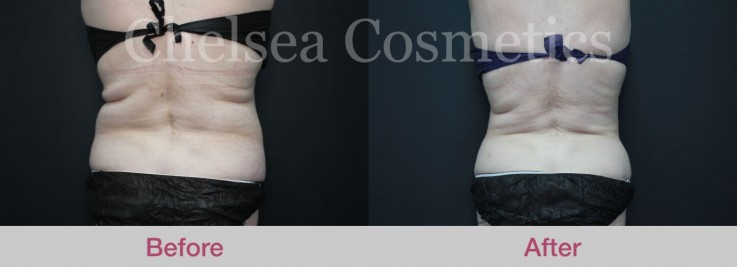 Get A Great Body With Chelsea Cosmetics' Liposuction Surgery in Melbourne - Contact Us Today!