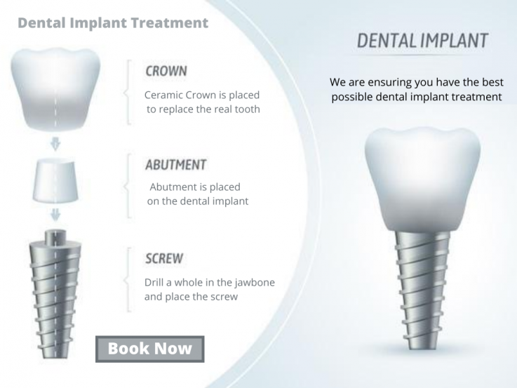 Dental Implants: Options, Procedure & Costs – Sleep Dream Smile