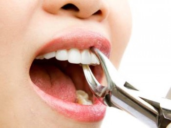 Cheap Wisdom Teeth Removal in Caroline Springs - Parkwood Green Dental