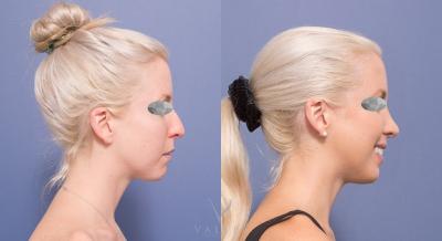 Rhinoplasty