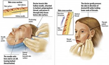 Best Silhouette Soft, Aptos & Mint Thread Face Lift in Melbourne Offered By Chelsea Cosmetics!