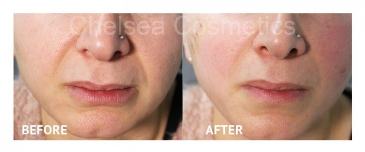 Best Silhouette Soft, Aptos & Mint Thread Face Lift in Melbourne Offered By Chelsea Cosmetics!