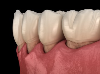 Best Root Canal Treatment- Springvale Dental