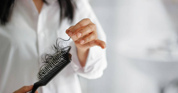 What is androgenetic alopecia?