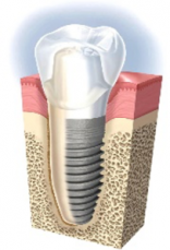 False Teeth Implants Near Me