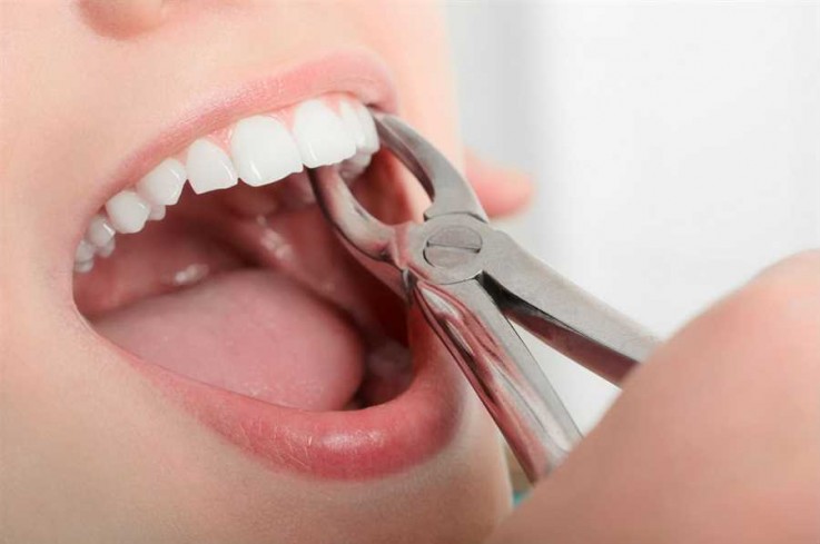 Painless Tooth Extraction by the Dentist of Carrum Downs Dental Group