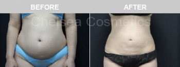 Effective Liposuction Surgery in Melbourne Performed By Chelsea Cosmetics Melbourne!