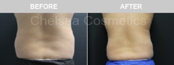 Effective Liposuction Surgery in Melbourne Performed By Chelsea Cosmetics Melbourne!