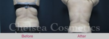 Effective Liposuction Surgery in Melbourne Performed By Chelsea Cosmetics Melbourne!