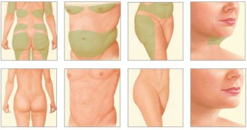 Effective Liposuction Surgery in Melbourne Performed By Chelsea Cosmetics Melbourne!
