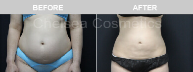 Effective Liposuction Surgery in Melbourne Performed By Chelsea Cosmetics Melbourne!