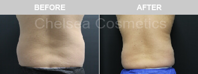 Effective Liposuction Surgery in Melbourne Performed By Chelsea Cosmetics Melbourne!