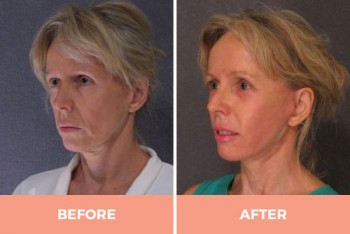 Professional Forehead & Eyebrow Lift Surgery in Sydney Performed By Dr Hodgkinson!