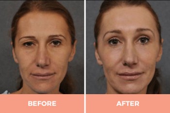 Professional Forehead & Eyebrow Lift Surgery in Sydney Performed By Dr Hodgkinson!