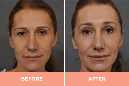Professional Forehead & Eyebrow Lift Surgery in Sydney Performed By Dr Hodgkinson!