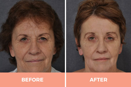 Professional Forehead & Eyebrow Lift Surgery in Sydney Performed By Dr Hodgkinson!
