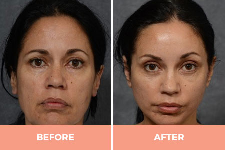 Professional Forehead & Eyebrow Lift Surgery in Sydney Performed By Dr Hodgkinson!