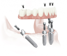 Malo Dental Implants Clinic In Australia