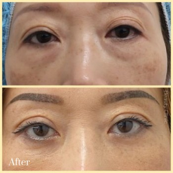 Restore A Youthful Facial Aesthetic with the Minimal Invasive Surgery by Lumiere Beauty Clinic!