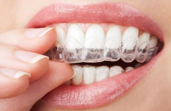 Invisalign Braces Adelaide