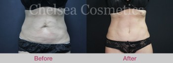 Get the Flat, Contoured Stomach You’ve Always Wanted With This Tummy Tuck Surgery in Melbourne!