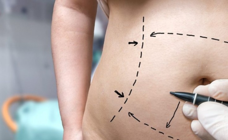 Get the Flat, Contoured Stomach You’ve Always Wanted With This Tummy Tuck Surgery in Melbourne!
