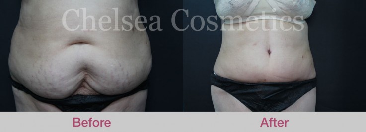 Get the Flat, Contoured Stomach You’ve Always Wanted With This Tummy Tuck Surgery in Melbourne!