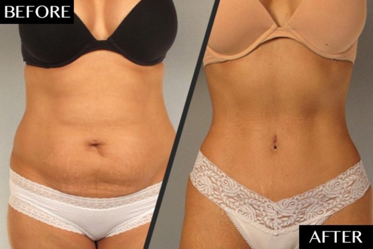Get the Flat, Contoured Stomach You’ve Always Wanted With This Tummy Tuck Surgery in Melbourne!