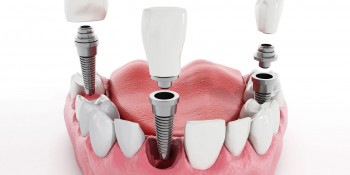 Best Dental implants Melbourne | Prahran Family Dental